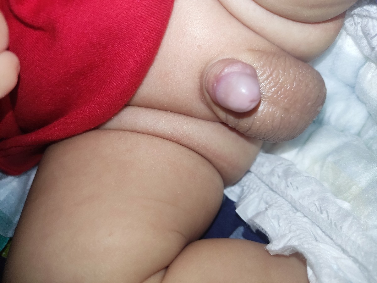 شکل آلت تناسلی نوزاد