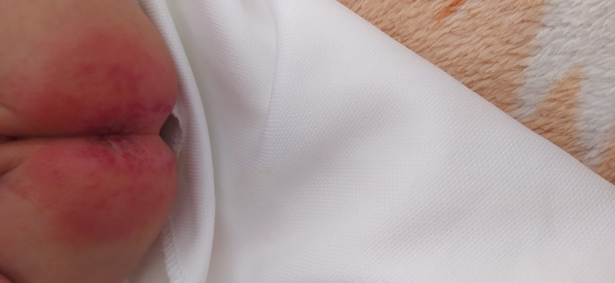 سوختگی مقعدنوزادک هیچ جوره خوب نمیشه سوختگی مقعدنوزادک هیچ جوره خوب نمیشه
