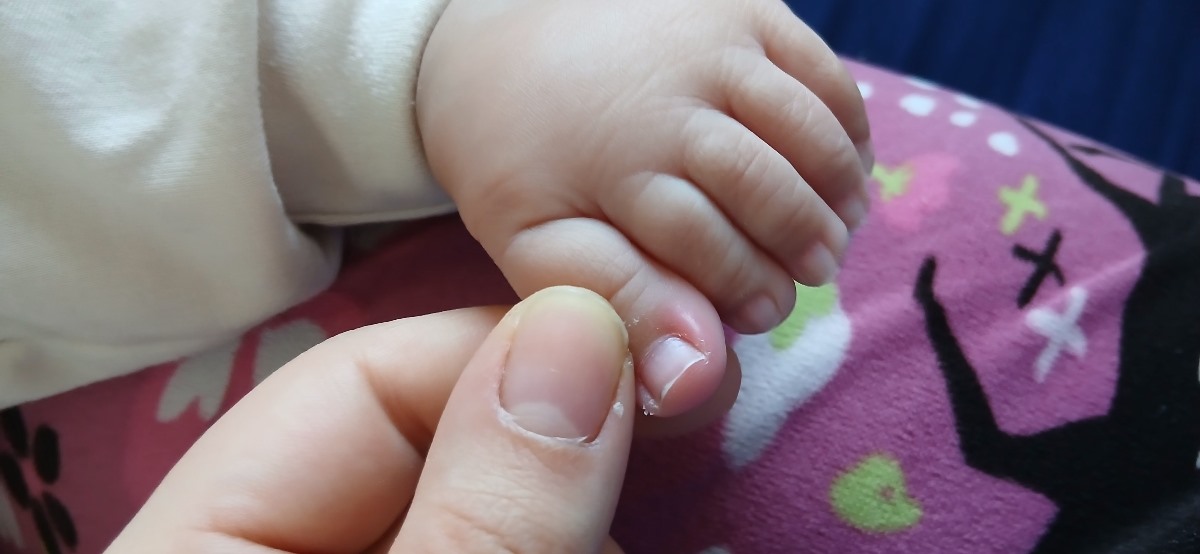 التهاب کنار ناخن نوزاد ۶ ماهه