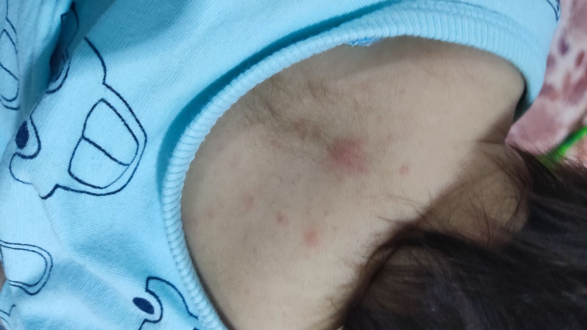آکنه قرمز روی بدن نوزاد آکنه قرمز روی بدن نوزاد