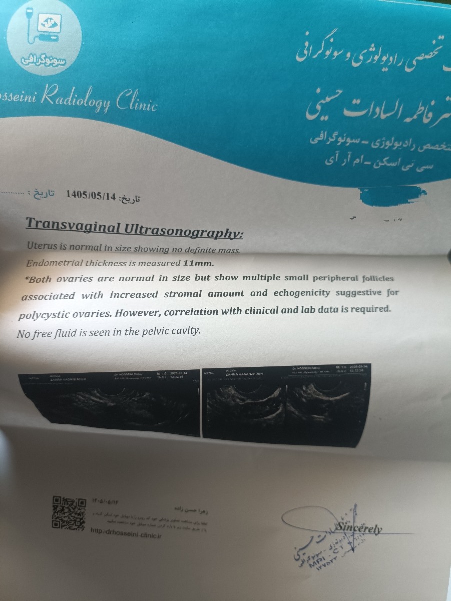 سونو گرافی تنبلی تخمدان شدید سونو گرافی تنبلی تخمدان شدید