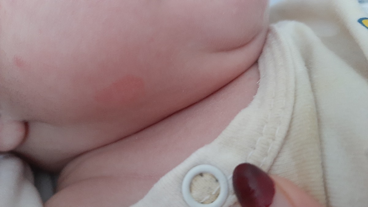خشکی پوست نوزاد ۵ماهه + عکس خشکی پوست نوزاد ۵ماهه + عکس