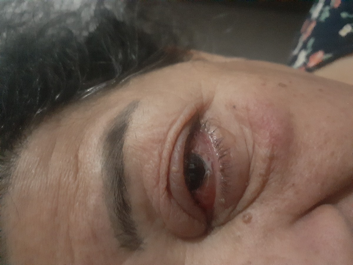 عفونت چشم با چای سبز ممکنه بهتر بشه؟
