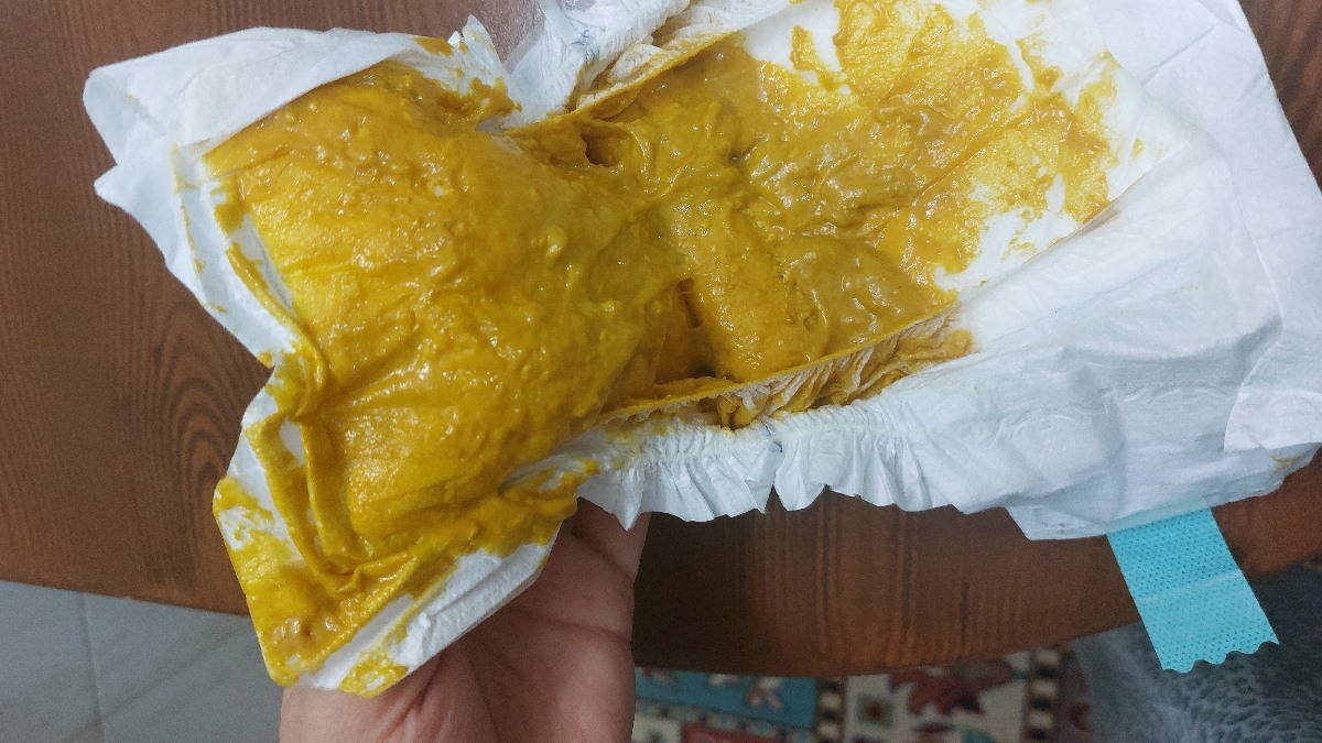علت مدفوع خمیری و دو دون نوزاد چیه