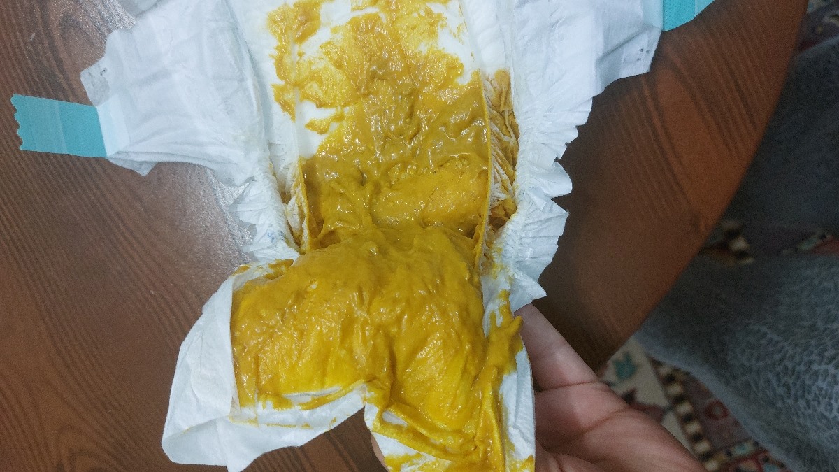 علت مدفوع خمیری و دو دون نوزاد چیه
