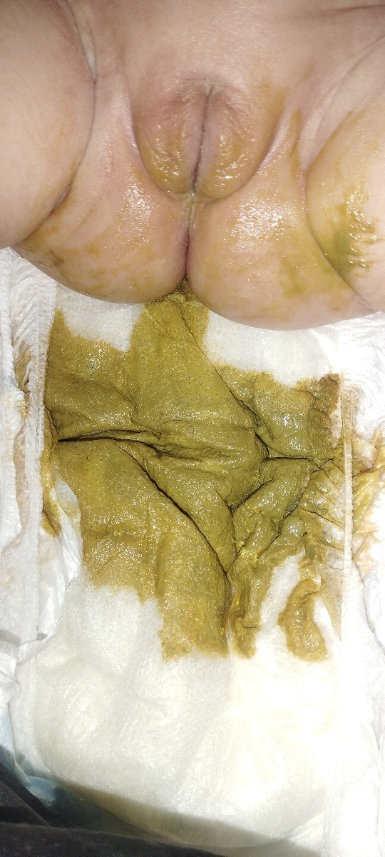 قوام مدفوع نوزاد 26روزه ❌عکس پوشک بچه داره بدت میاد نبین❌