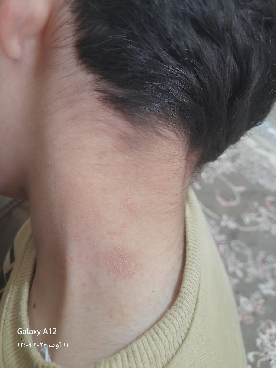 بیرون زدن دانه از گردن کودک 7ساله بیرون زدن دانه از گردن کودک 7ساله