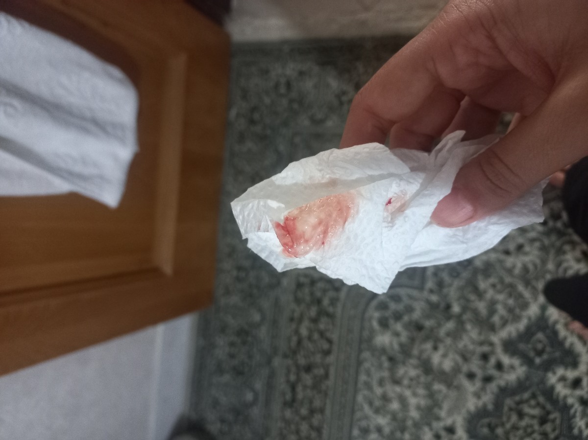 ❌❌❌لکه بینی و قطع انوکساپارین اورژانسی❌❌❌❌