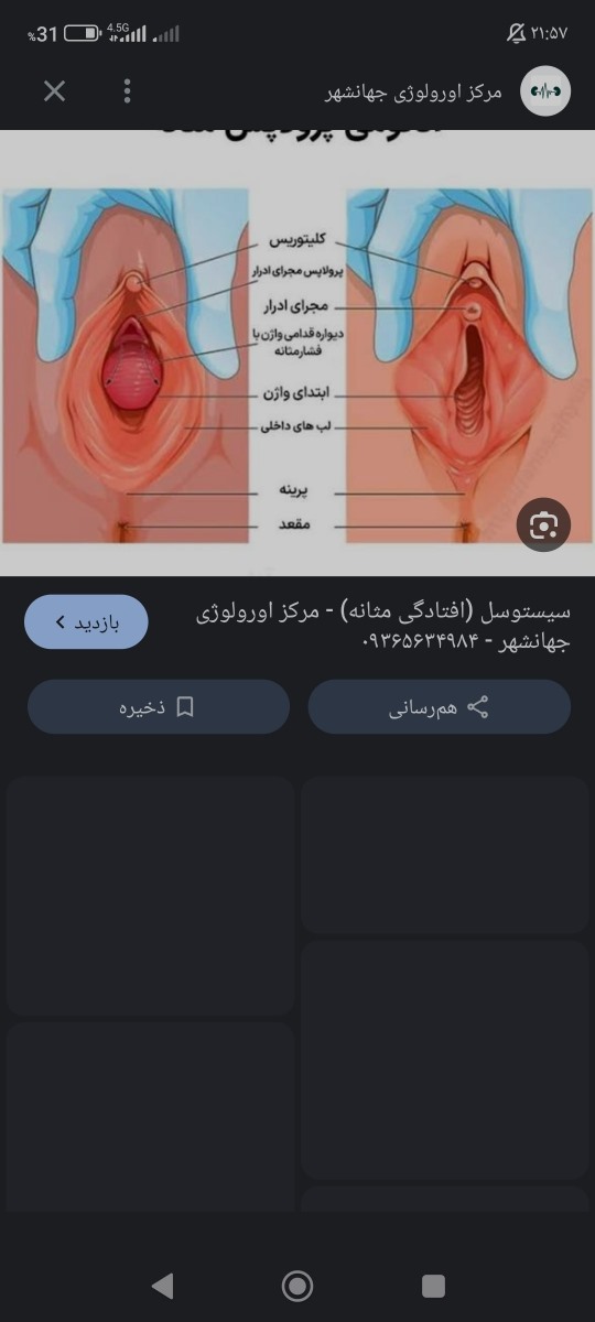 افتادگی واژن یا مثانه