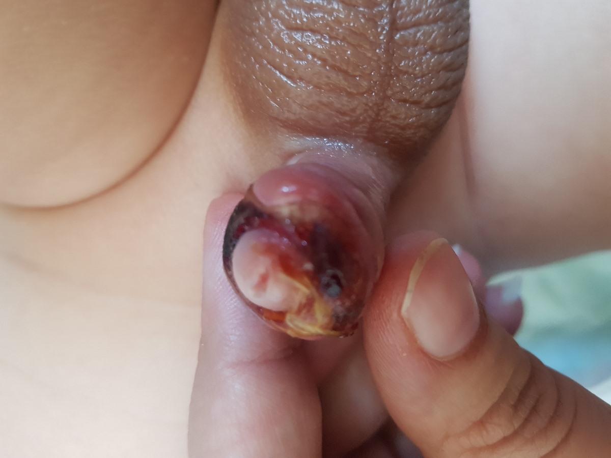 عکس ختنه نوزاد بعد ۹ روز ..فورری خانم دکتر😭