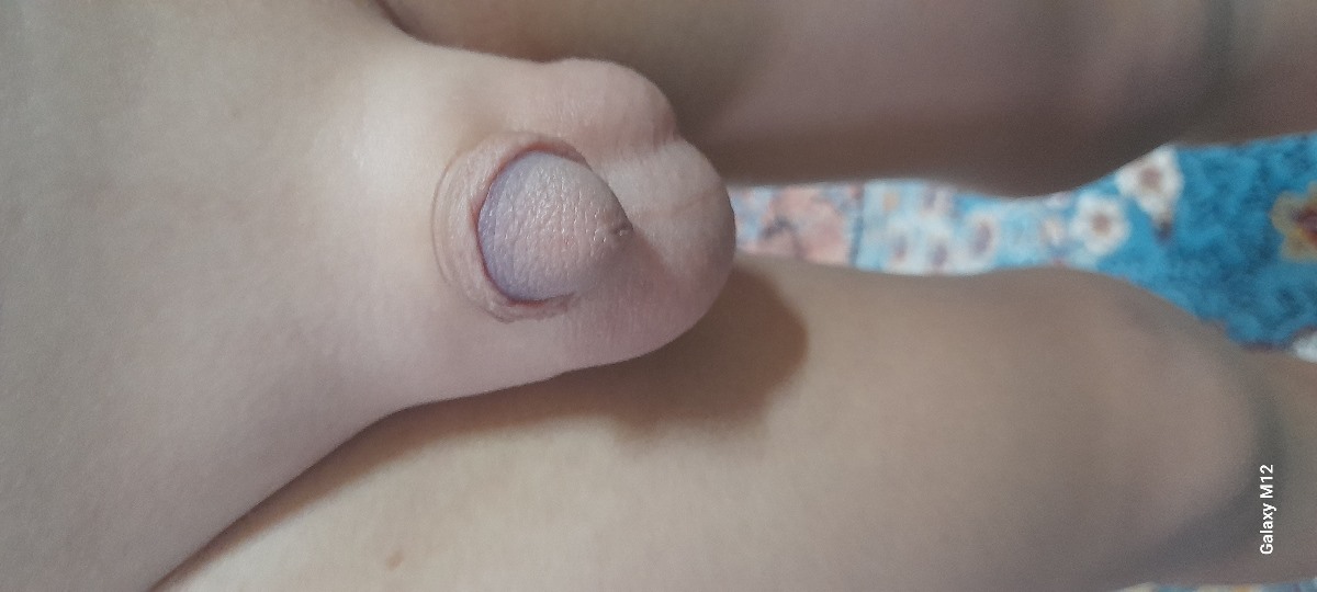 ورم اطراف بیضه کودک