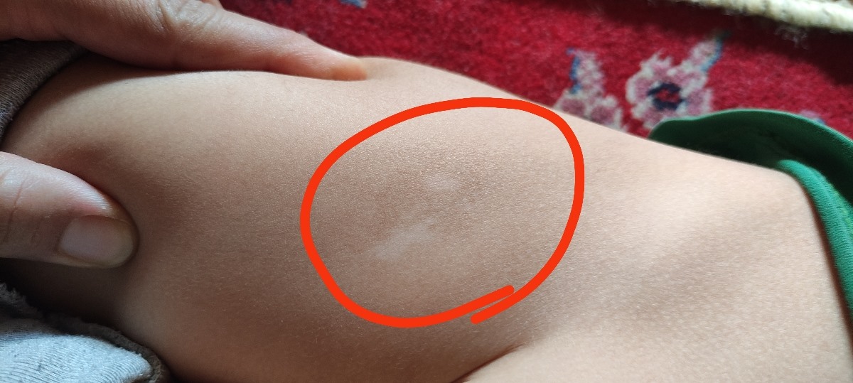 دکتر خال سفیدقهوه ای نوزاد کمک کنید لطفا