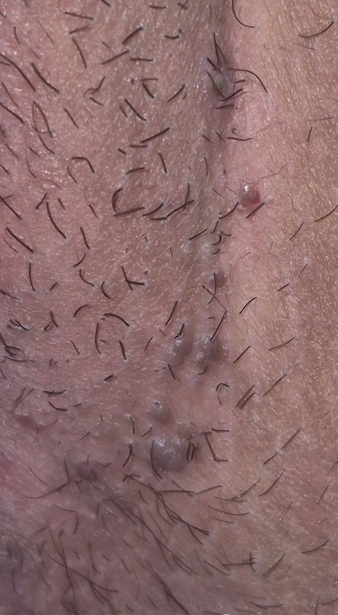 از روی این عکس میشه تشخیص داد اینا زگیل هست یا تبخال