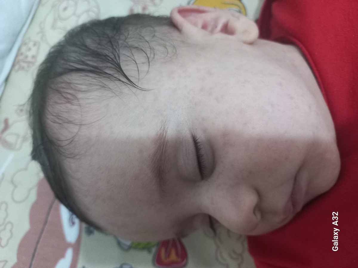 سرماخوردگی و دونه سیاه روی زبان نوزاد ۶ ماهه