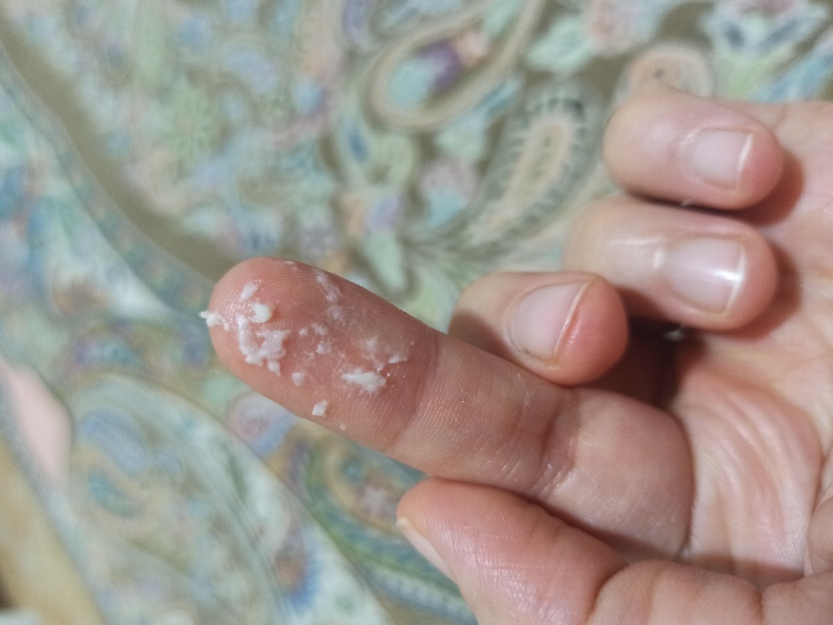 اوژانسی..خیلی خارش دارم وترشح