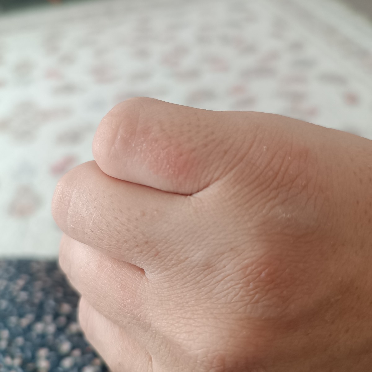 اگزما در بارداری و علت آن