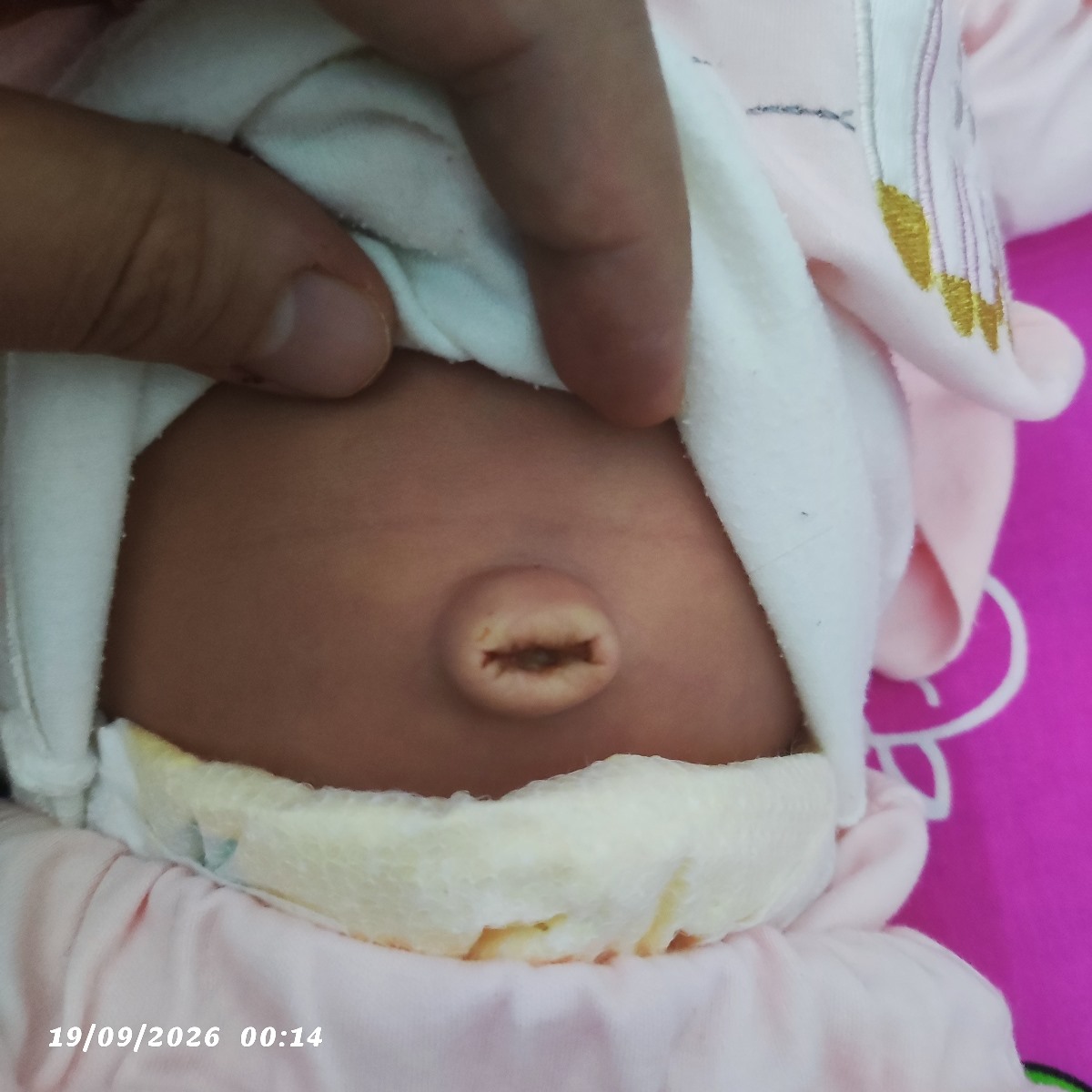 خانوم دکتر این ناف چرک کرده؟اورژانسی