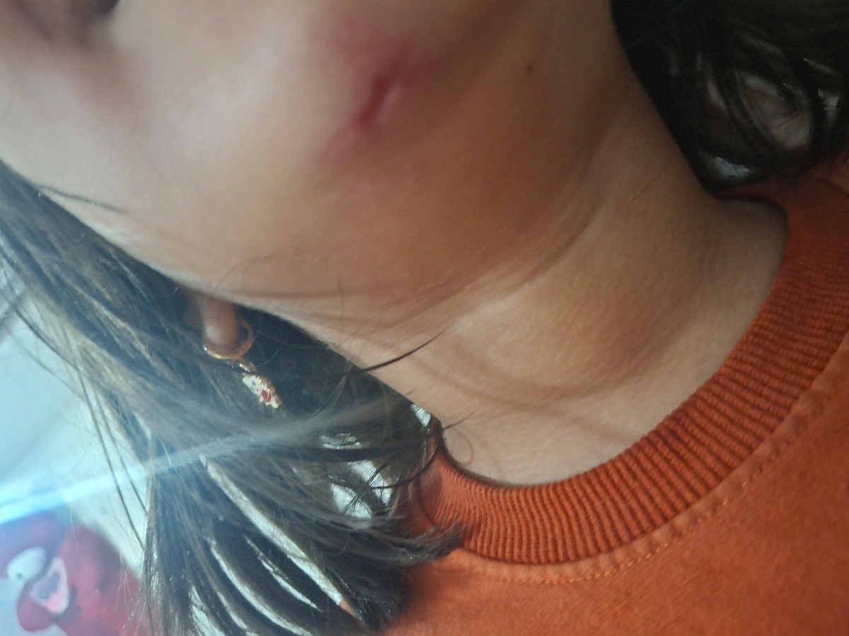 اورژانسی.. افتادن بچ روی آسفالت و زخم زیر چانه