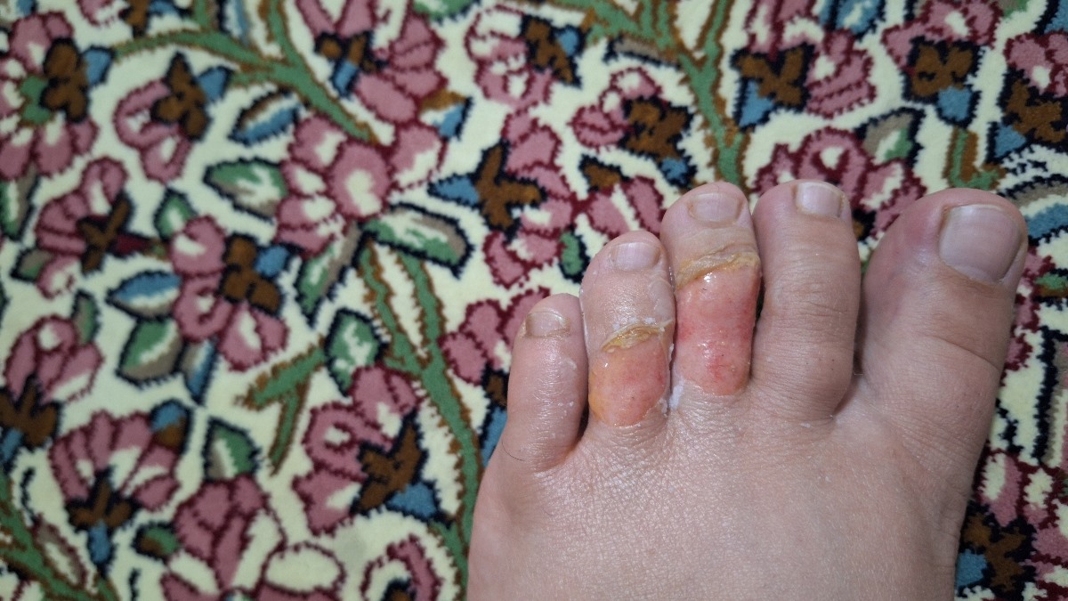 سوختگی انگشت های پا سوختگی انگشت های پا