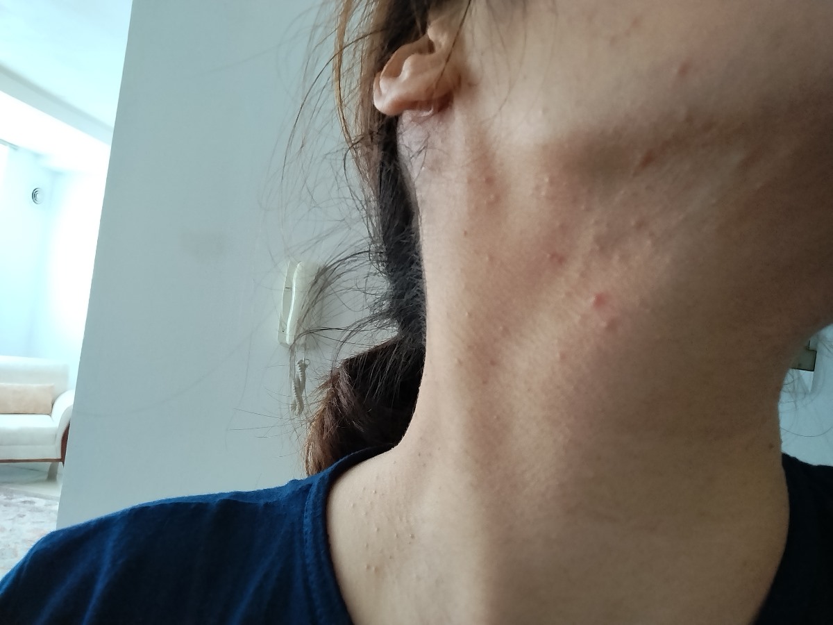 کهیر و جوش زیر گردن