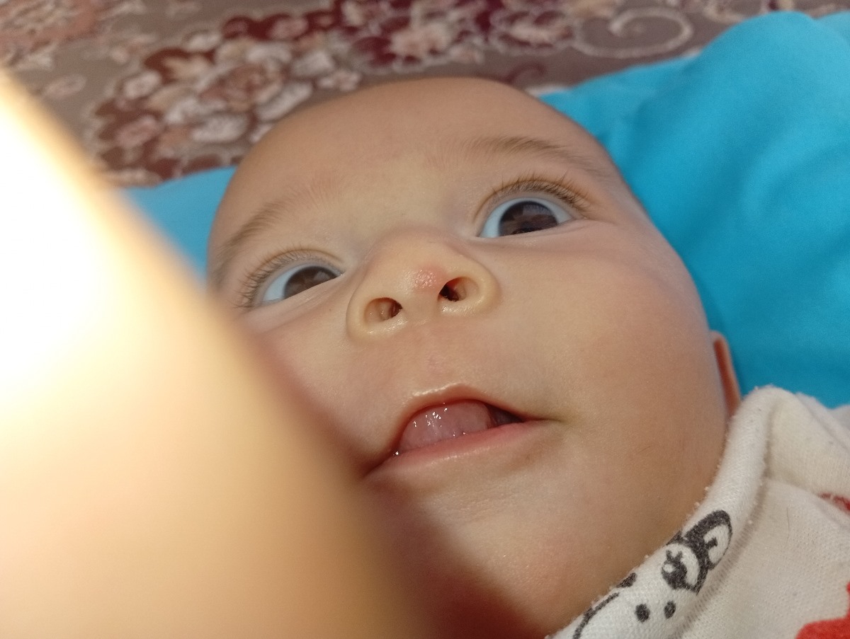 سلام دکتر جان تبخال روی بینی آنیا (اورژانسی)