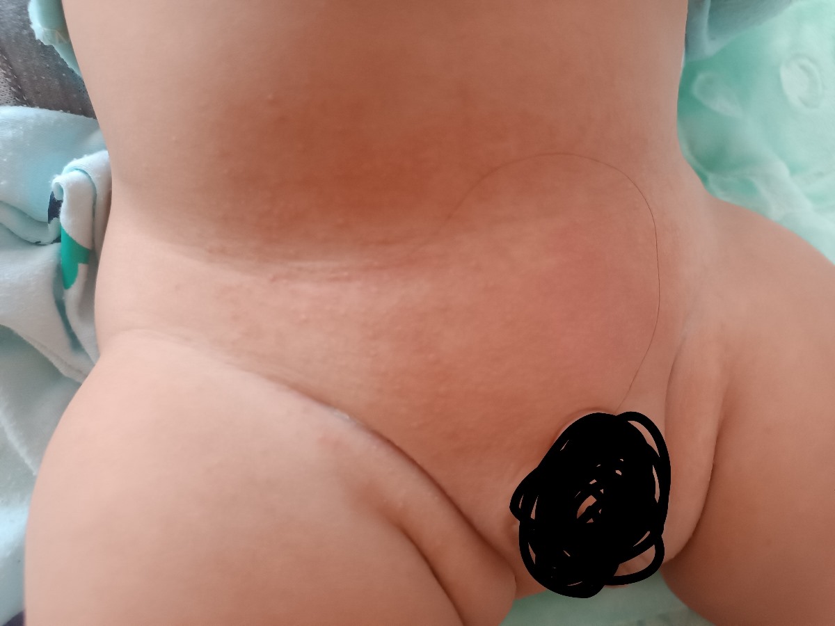 سلام سوختگی نوزاد شش ماهه سلام سوختگی نوزاد شش ماهه