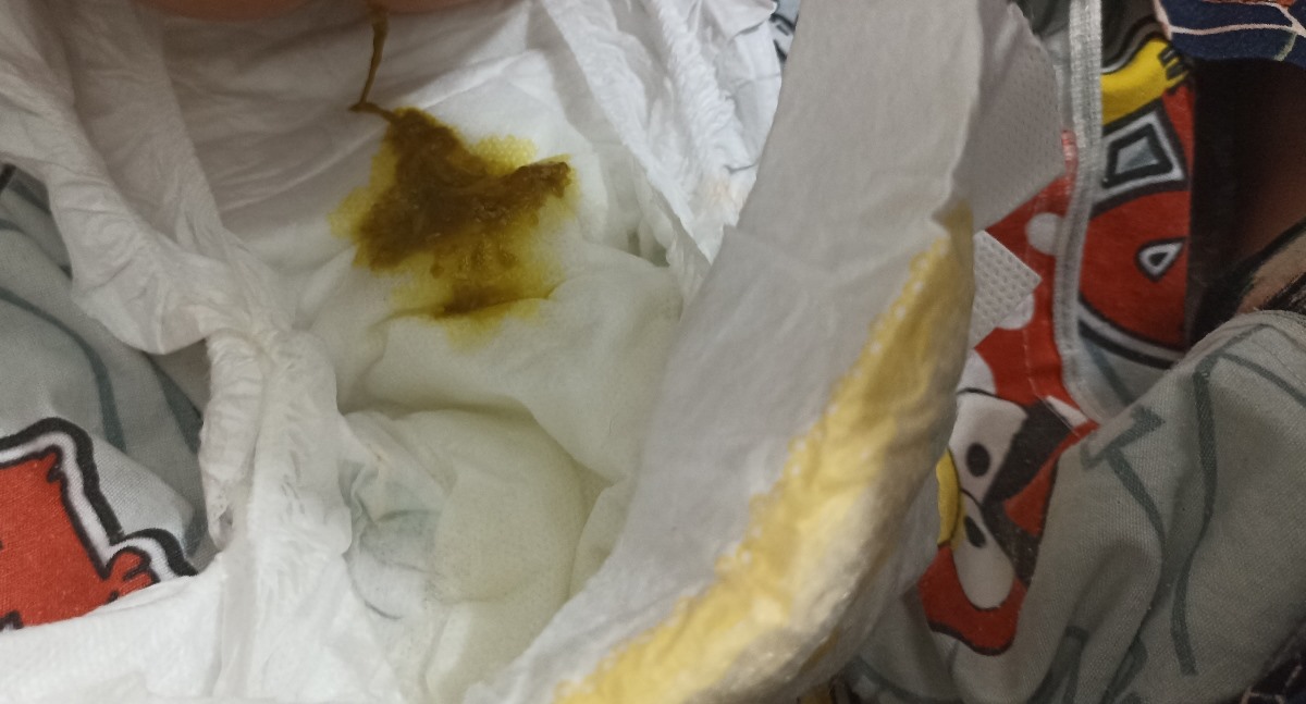 مدفوع خلطی نوزاد ۲ماهه مدفوع خلطی نوزاد ۲ماهه
