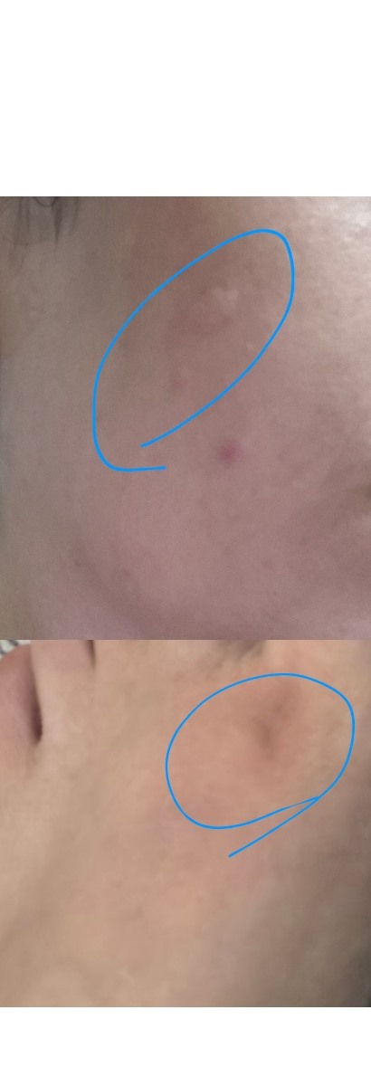 ❌️❌️خانم دکتر اورژانسی زدن کهیر در هفته ۱۰ بارداری