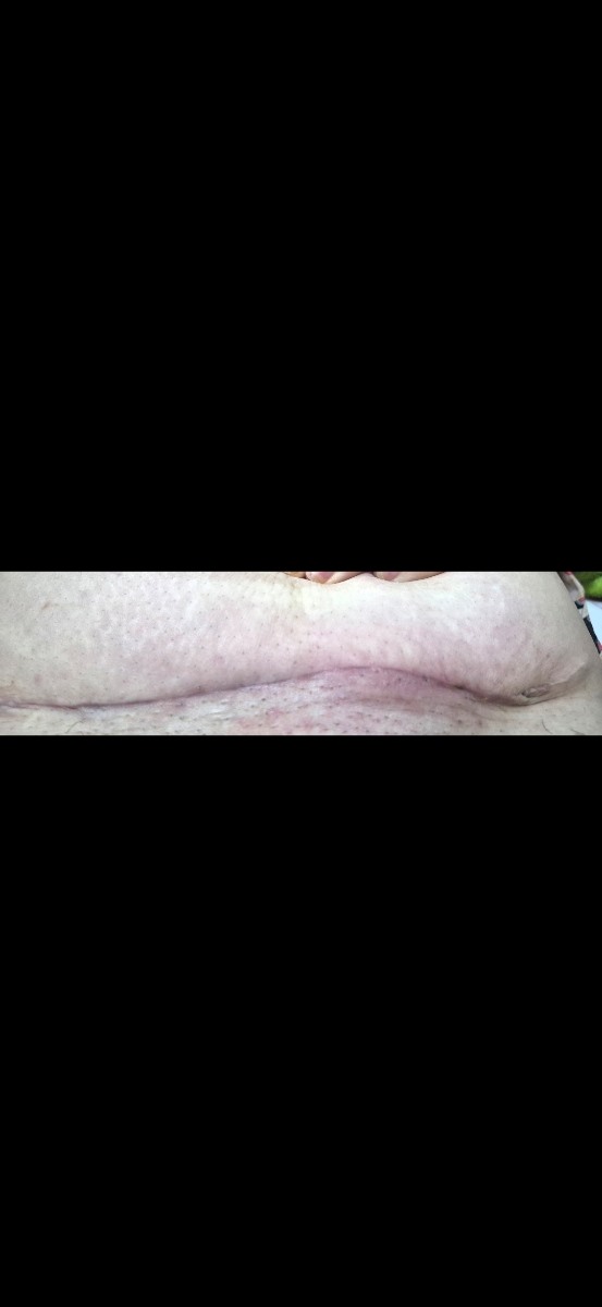 لطفا برای عفونت جای بخیه سزارین