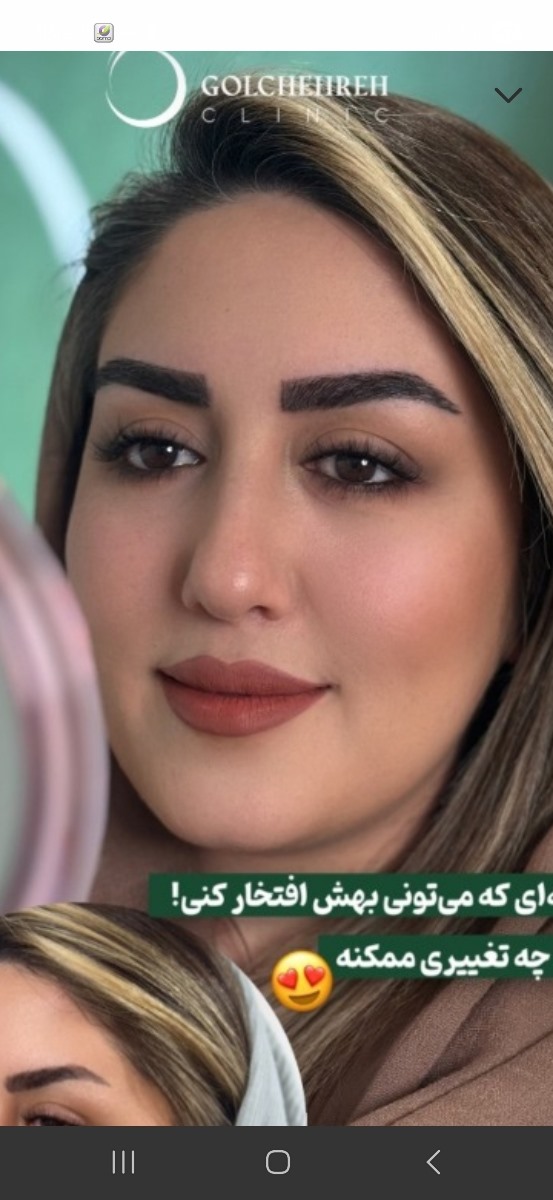 کسی هست اینجا کاشت ابرو انجام داده باشه؟