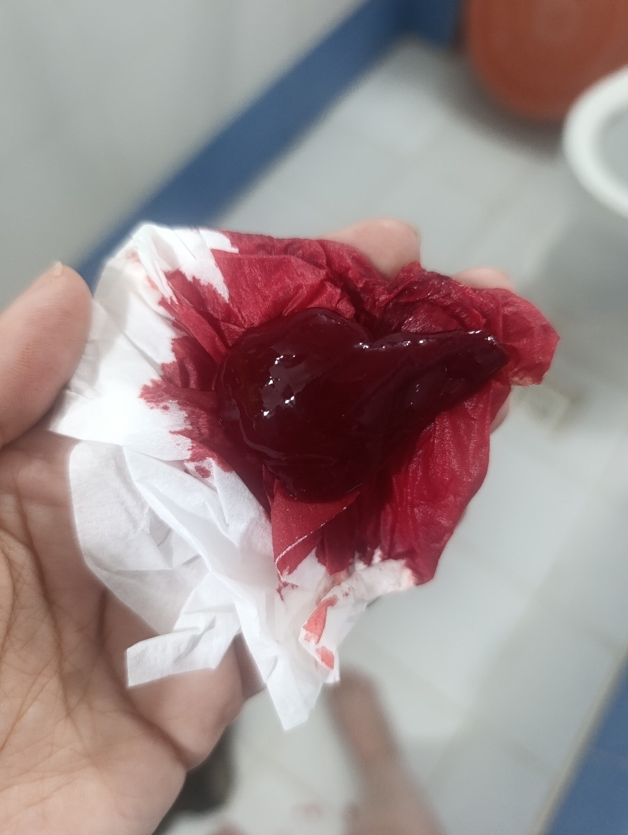 سقط جنین با هماتوم بارداری